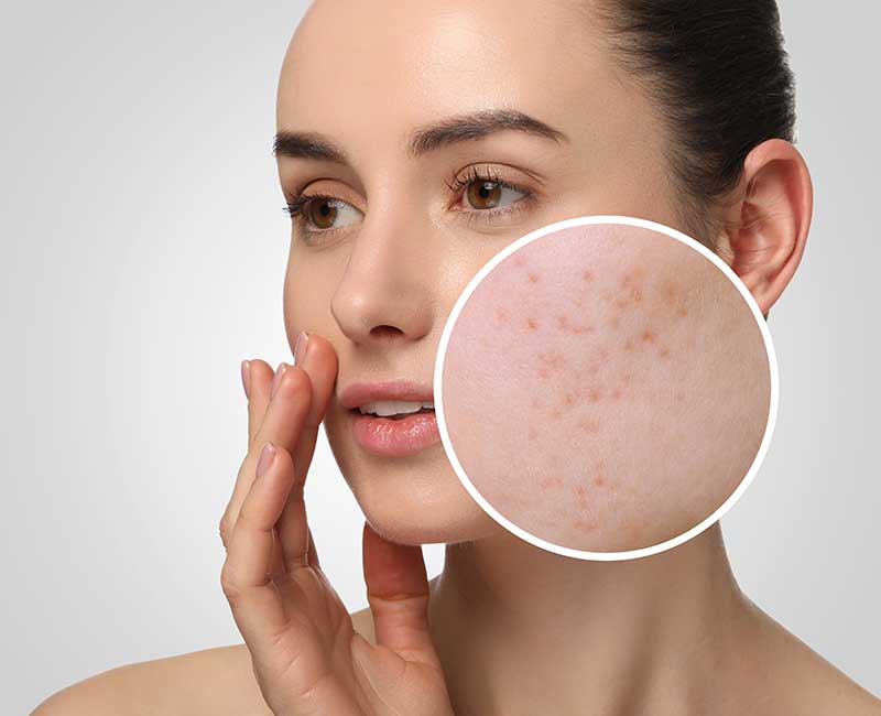 pelle acneica cure